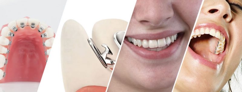 Lingual braces – Dental Art Tourism